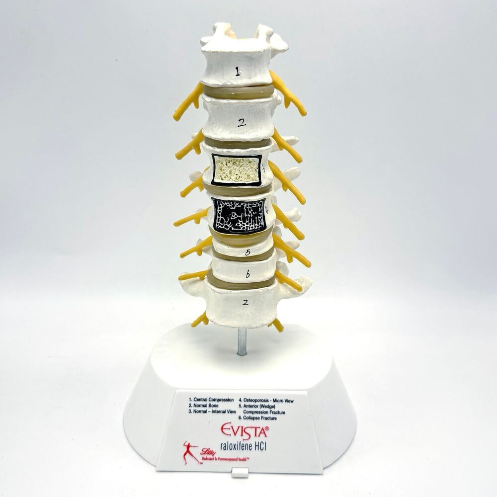 Lumbar Spine Vertebrae Model Anatomical Vertebral Medical Display Osteoporosis